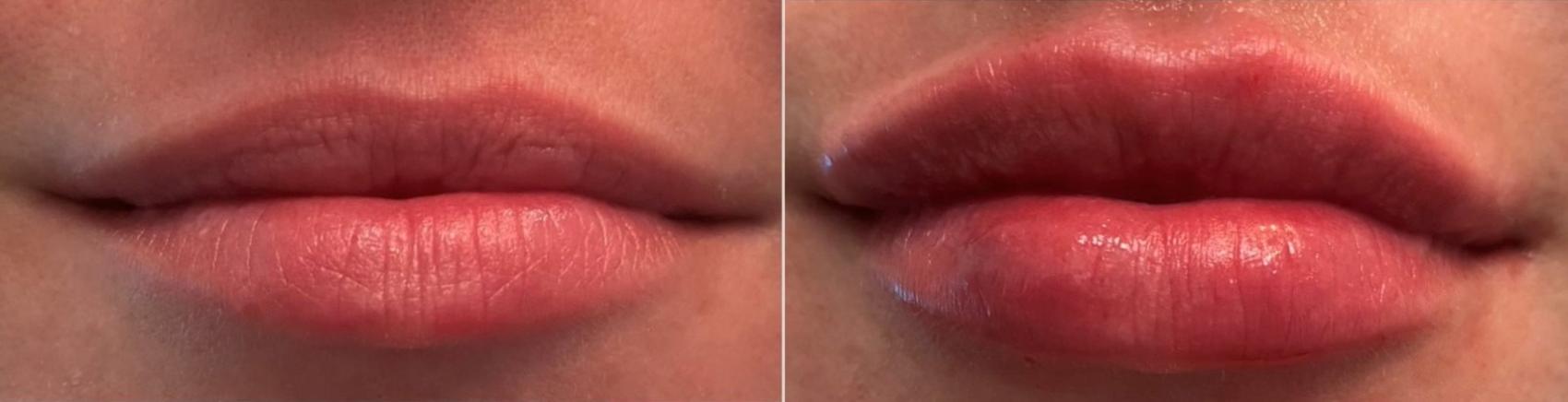 Dermal Fillers Before And After Pictures Case Port Richey Fl