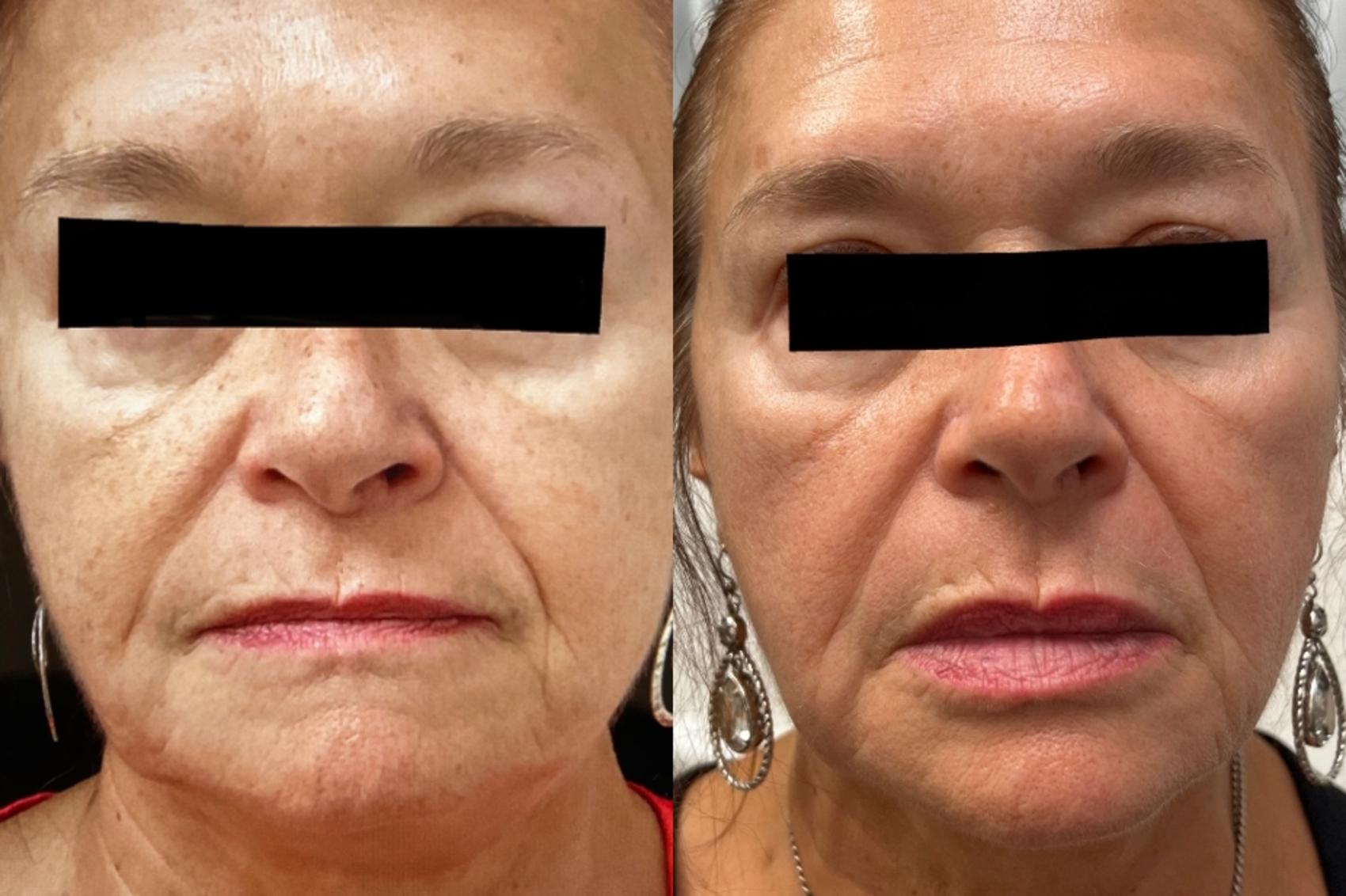 Before & After Dermal Fillers Case 10 Front View in Port Richey, FL