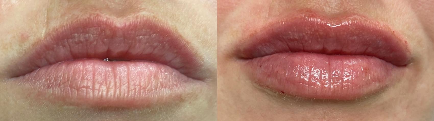 Before & After Dermal Fillers Case 11 Front View in Port Richey, FL