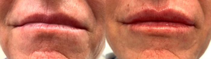 Before & After Dermal Fillers Case 12 Front View in Port Richey, FL