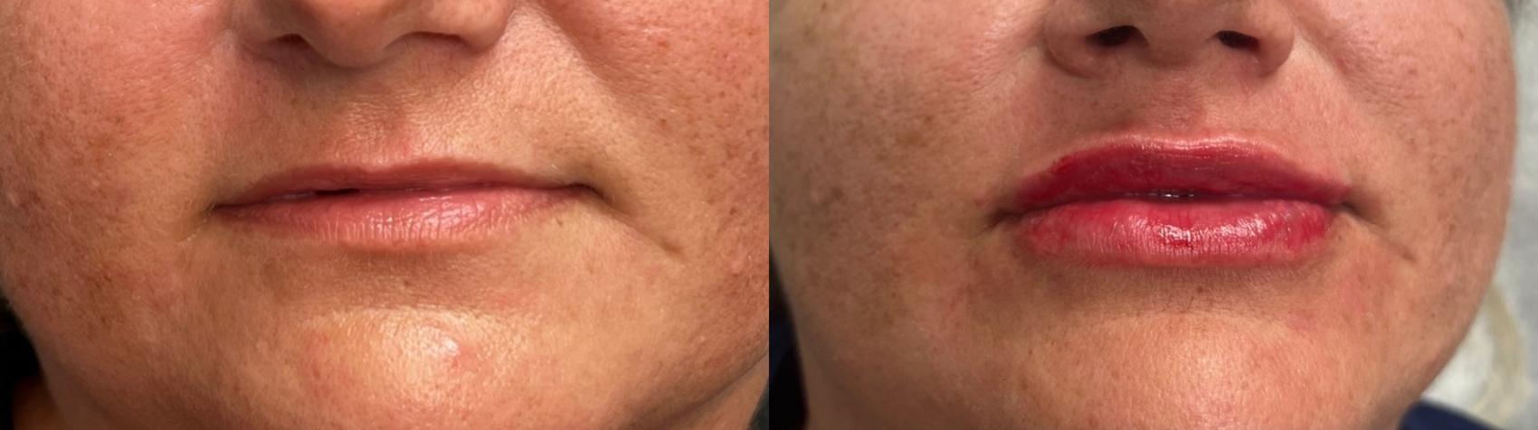 Before & After Dermal Fillers Case 13 Front View in Port Richey, FL