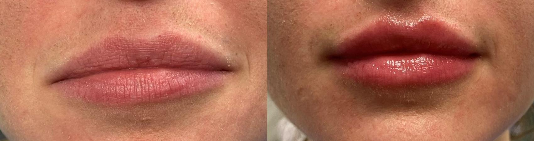 Before & After Dermal Fillers Case 3 Front View in Port Richey, FL