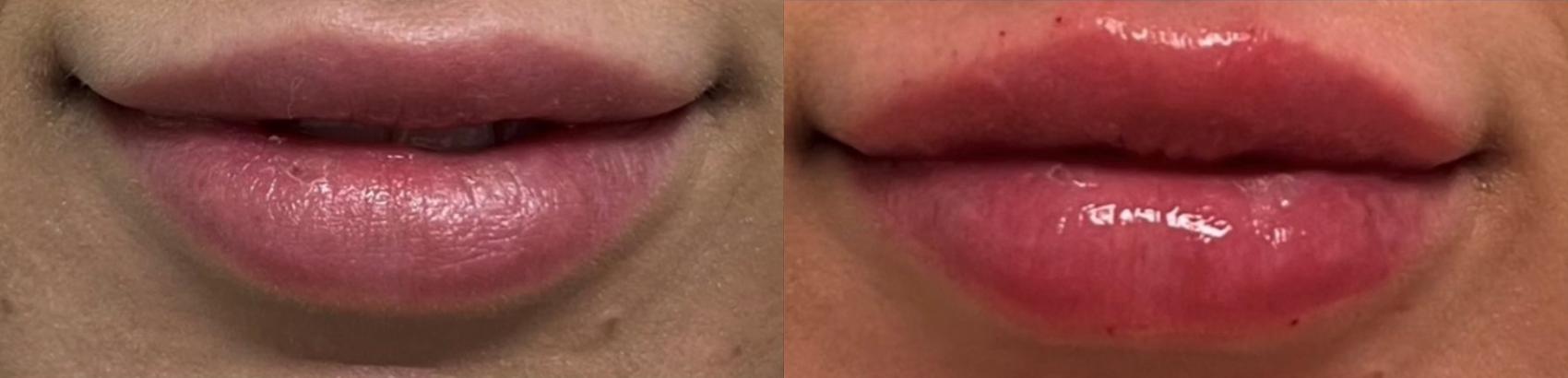 Before & After Dermal Fillers Case 5 Front View in Port Richey, FL
