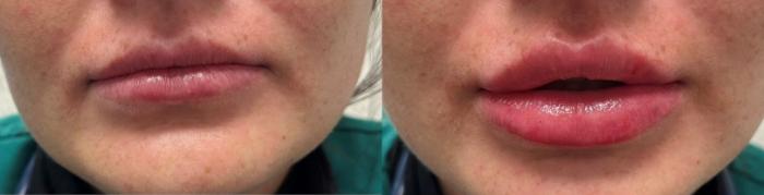 Before & After Dermal Fillers Case 6 Front View in Port Richey, FL