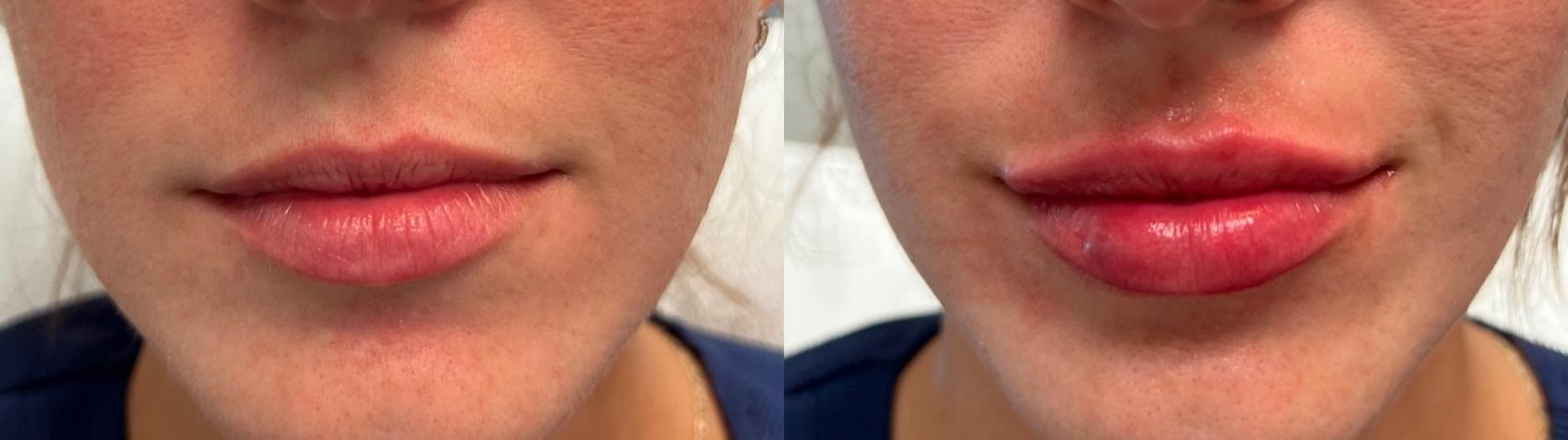 Before & After Dermal Fillers Case 8 Front View in Port Richey, FL