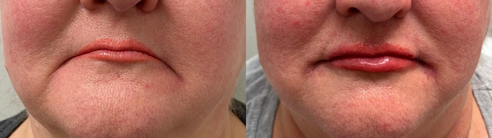 Before & After Dermal Fillers Case 9 Front View in Port Richey, FL